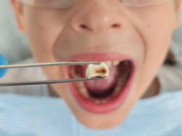 Best Emergency Wisdom Teeth Removal in Ironton, OH